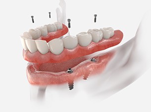 Digital image of dental implants