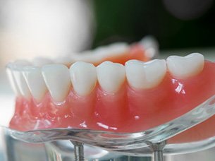 Close up of model dentures sitting on a transparent stand